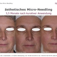 Micro Needling Vorher-Nachher-Bilder