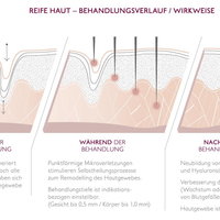 Behandlungsverlauf von Micro Needling